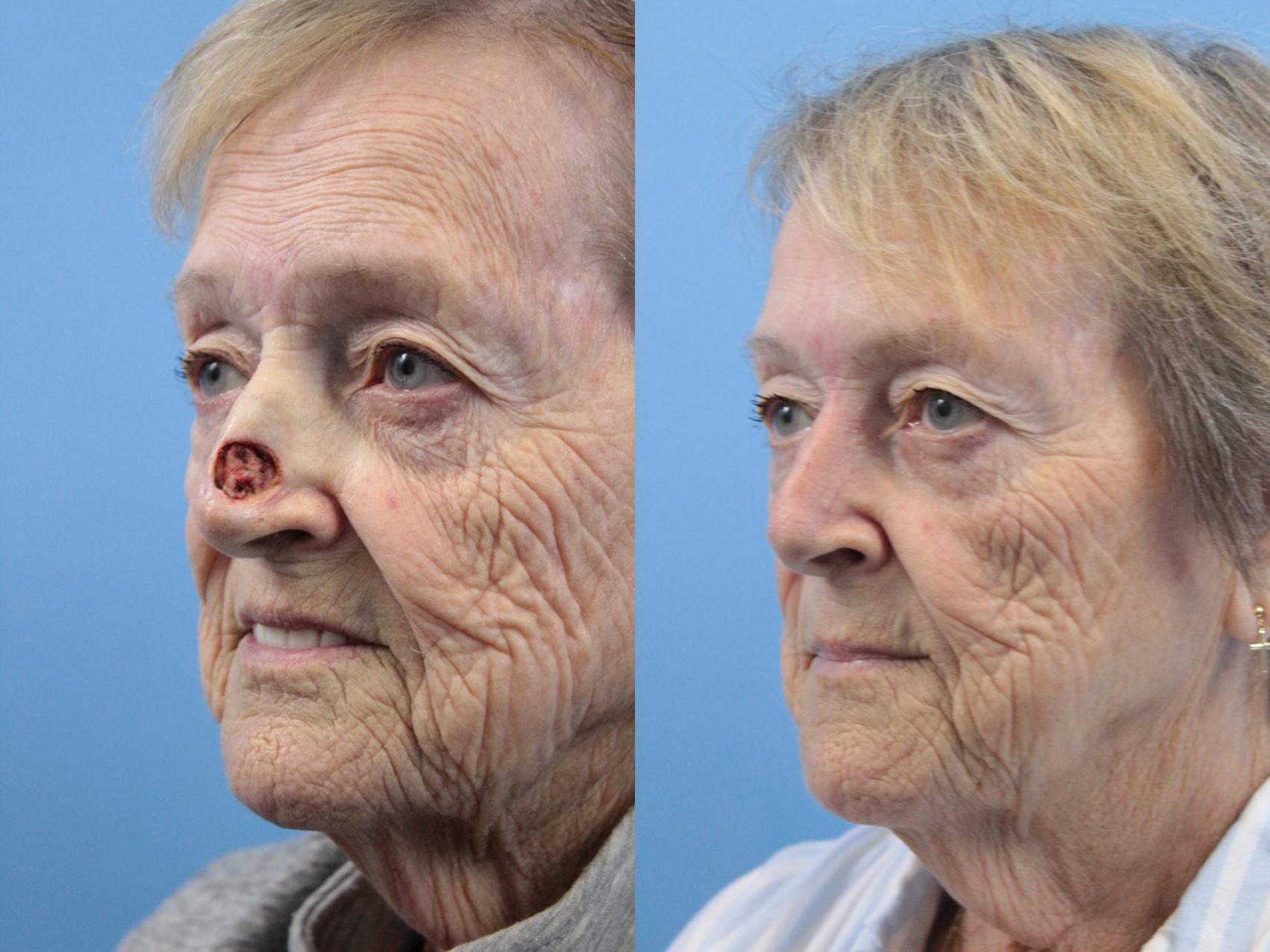 Before & After Skin Cancer Repair Case 260 Left Oblique View in West Des Moines & Ames, IA