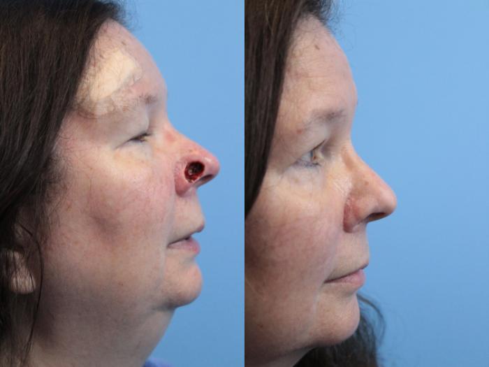 Before & After Skin Cancer Repair Case 262 Right Side View in West Des Moines & Ames, IA
