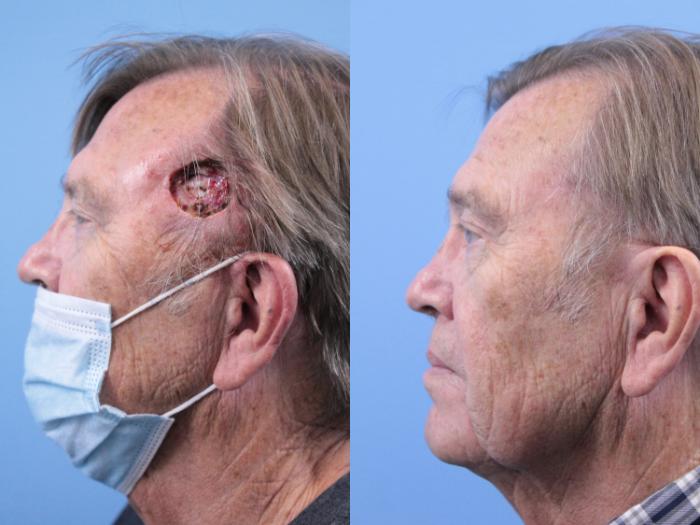 Before & After Skin Cancer Repair Case 263 Left Side View in West Des Moines & Ames, IA
