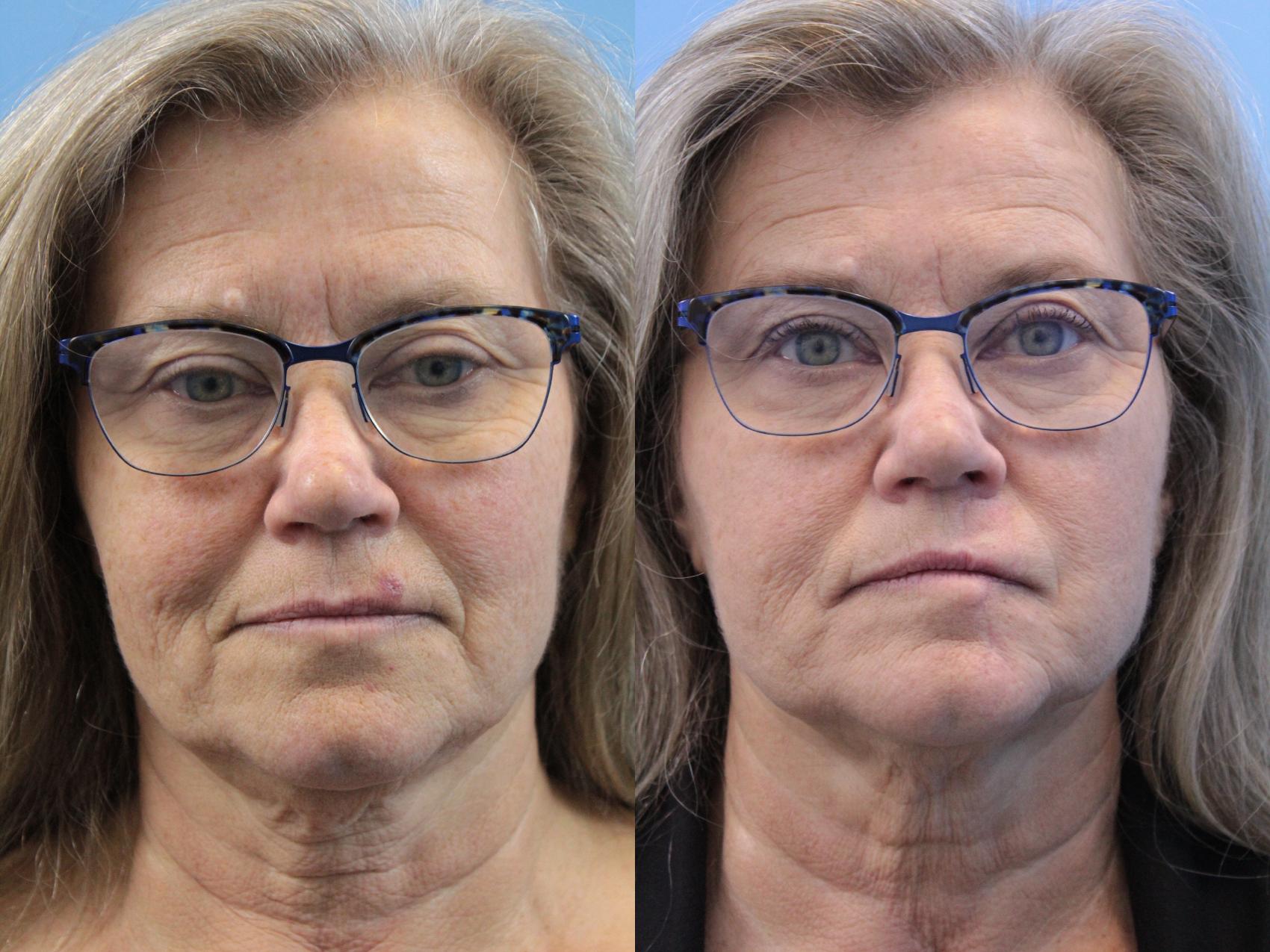 Before & After Skin Cancer Repair Case 264 Front View in West Des Moines & Ames, IA
