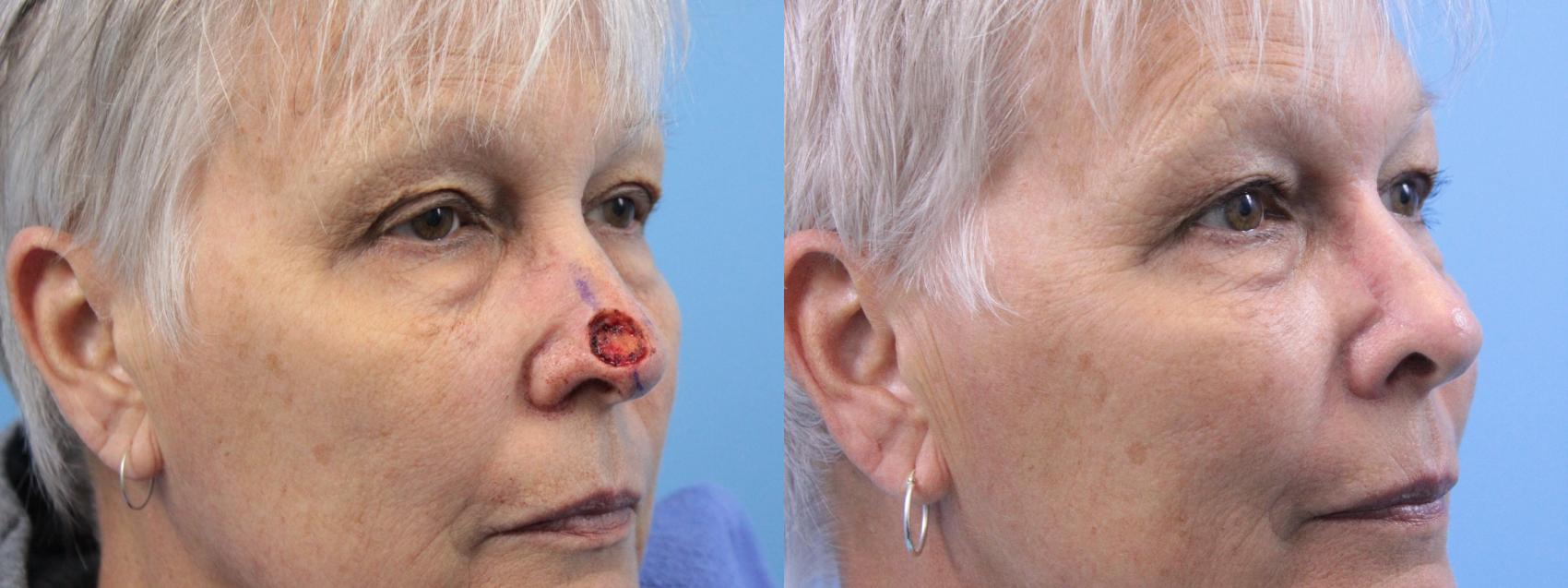 Before & After Skin Cancer Repair Case 265 Right Oblique View in West Des Moines & Ames, IA