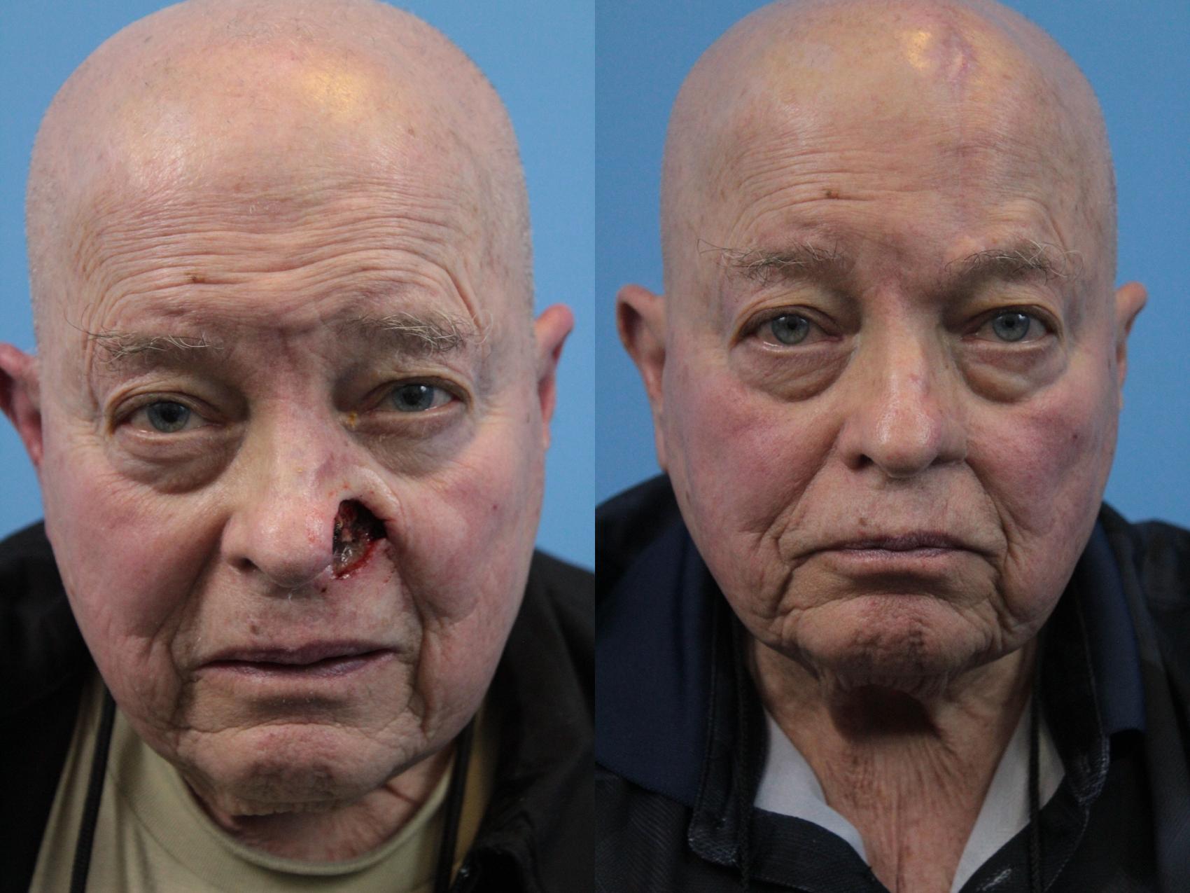 Before & After Skin Cancer Repair Case 283 Front View in West Des Moines & Ames, IA