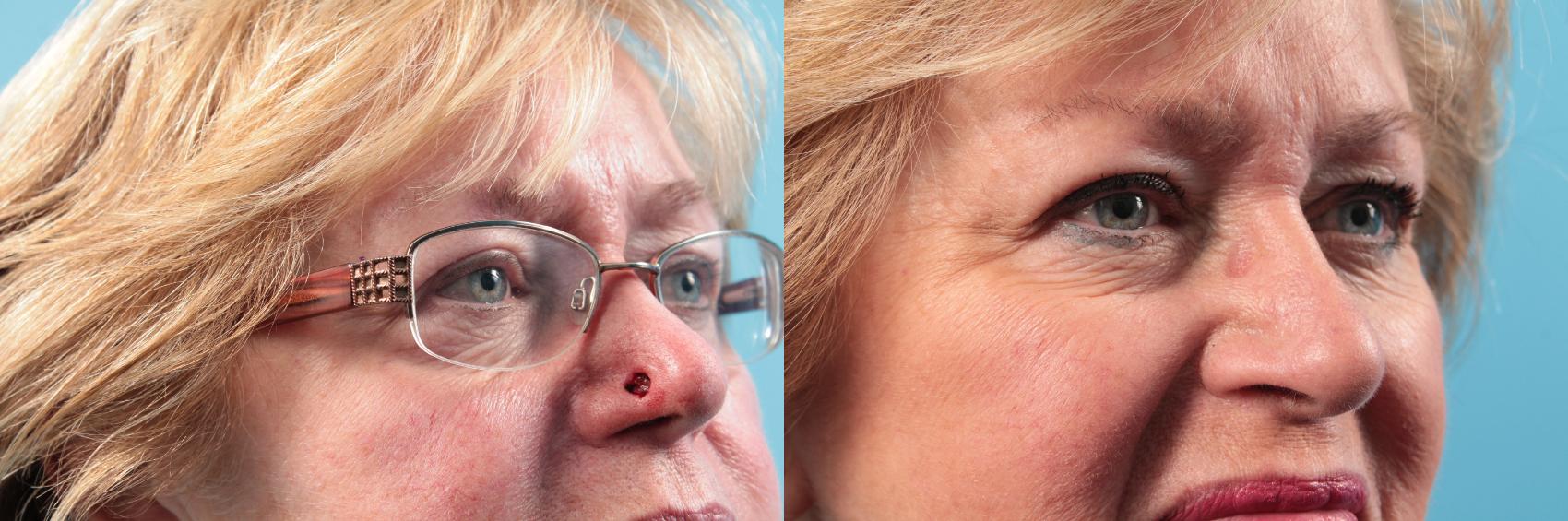 Before & After Skin Cancer Repair Case 35 View #1 View in West Des Moines & Ames, IA