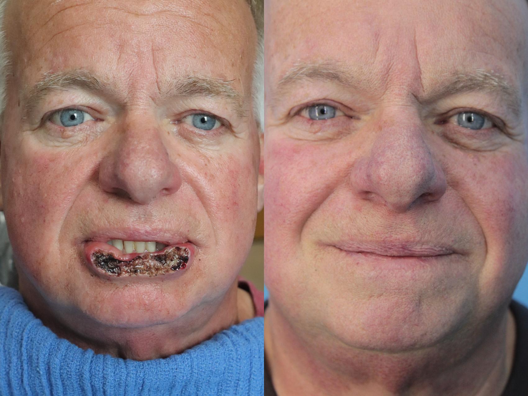 Before & After Skin Cancer Repair Case 384 Front View in West Des Moines & Ames, IA
