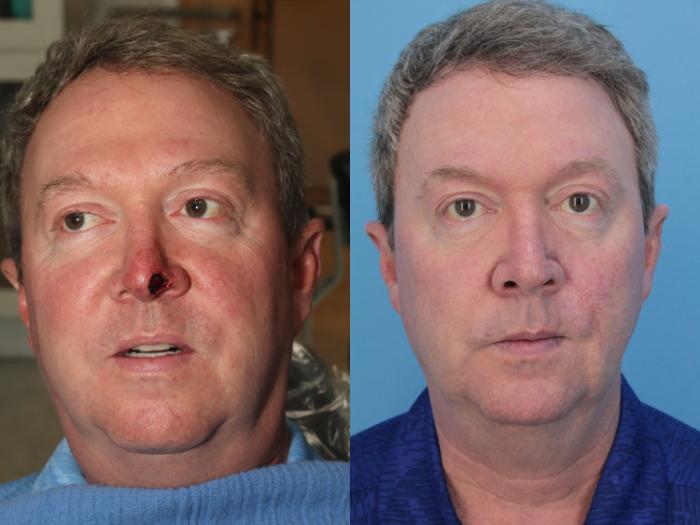 Before & After Skin Cancer Repair Case 401 Front View in West Des Moines & Ames, IA