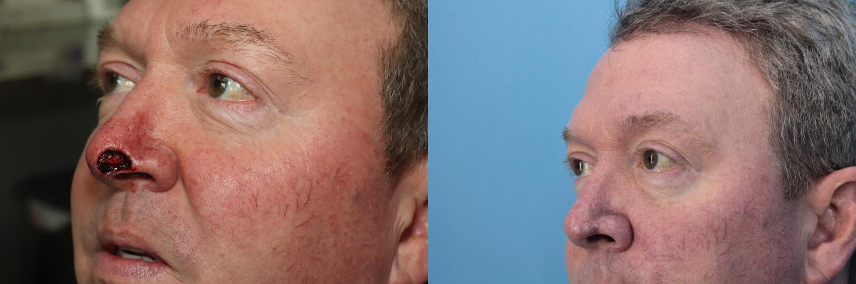 Before & After Skin Cancer Repair Case 401 Left Oblique View in West Des Moines & Ames, IA