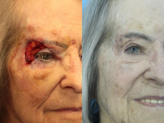 Before & After Skin Cancer Repair Case 414 Front View in West Des Moines & Ames, IA