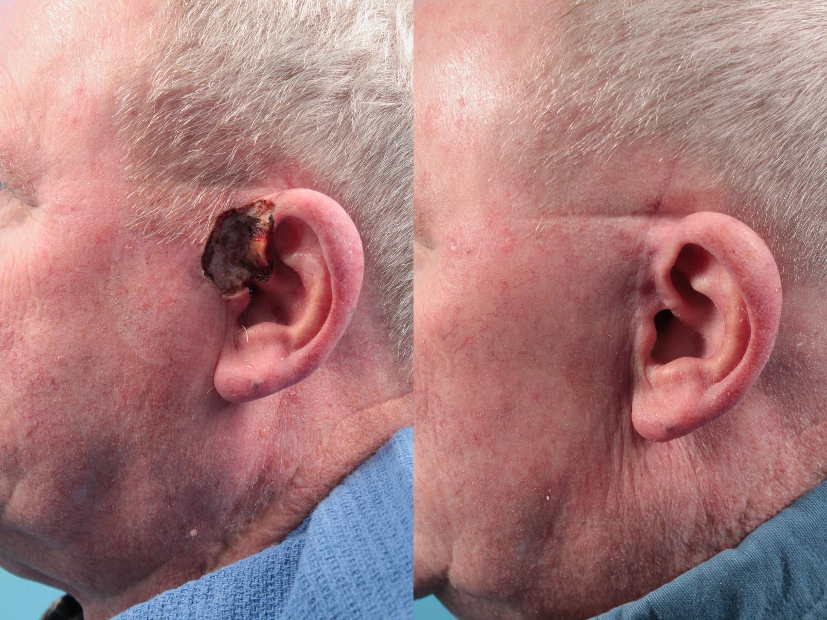Before & After Skin Cancer Repair Case 42 View #1 View in West Des Moines & Ames, IA
