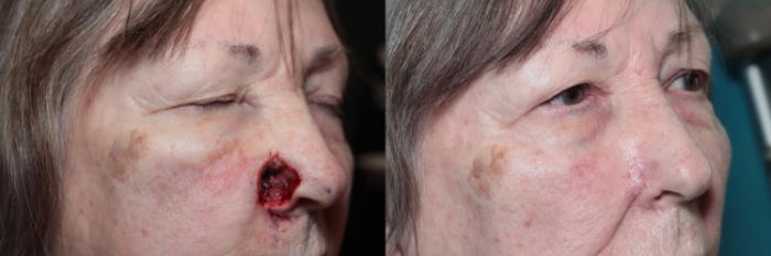 Before & After Skin Cancer Repair Case 421 Right Side View in West Des Moines & Ames, IA