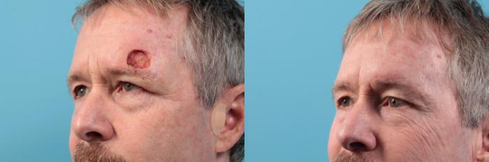Before & After Skin Cancer Repair Case 43 View #2 View in West Des Moines & Ames, IA