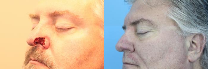 Before & After Skin Cancer Repair Case 434 Front View in West Des Moines & Ames, IA