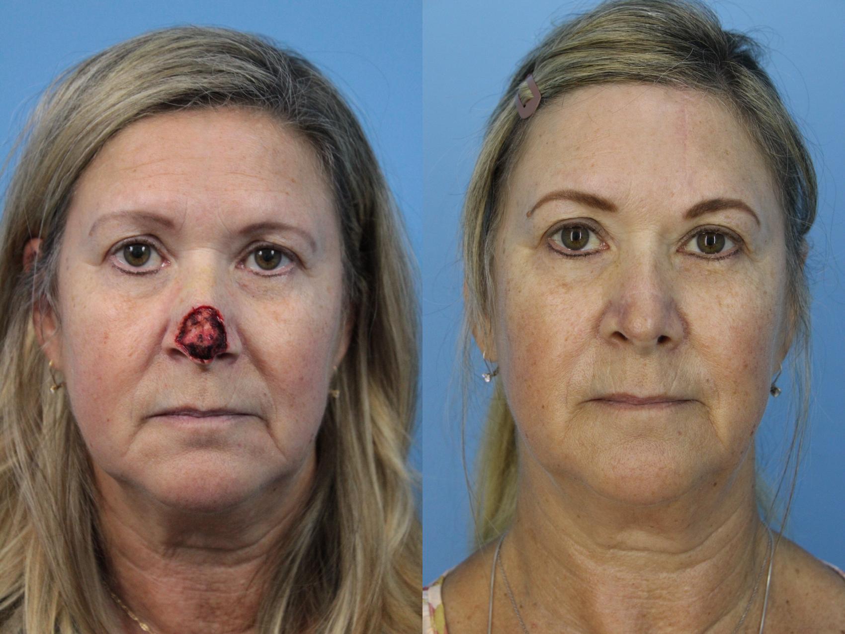 Before & After Skin Cancer Repair Case 443 Front View in West Des Moines & Ames, IA