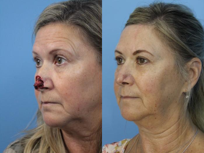 Before & After Skin Cancer Repair Case 443 Left Oblique View in West Des Moines & Ames, IA