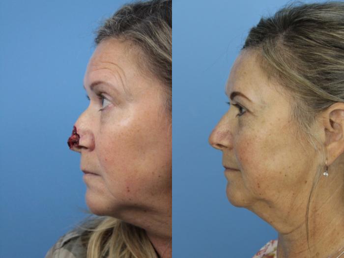 Before & After Skin Cancer Repair Case 443 Left Side View in West Des Moines & Ames, IA