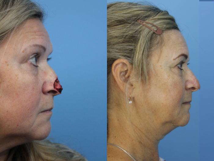 Before & After Skin Cancer Repair Case 443 Right Side View in West Des Moines & Ames, IA