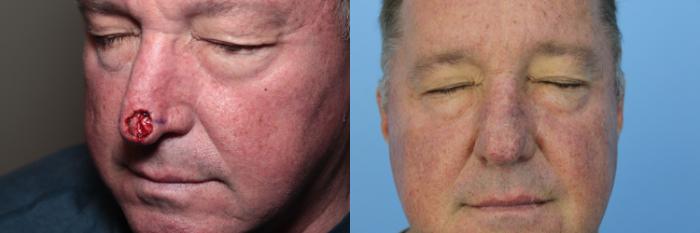 Before & After Skin Cancer Repair Case 456 Front View in West Des Moines & Ames, IA