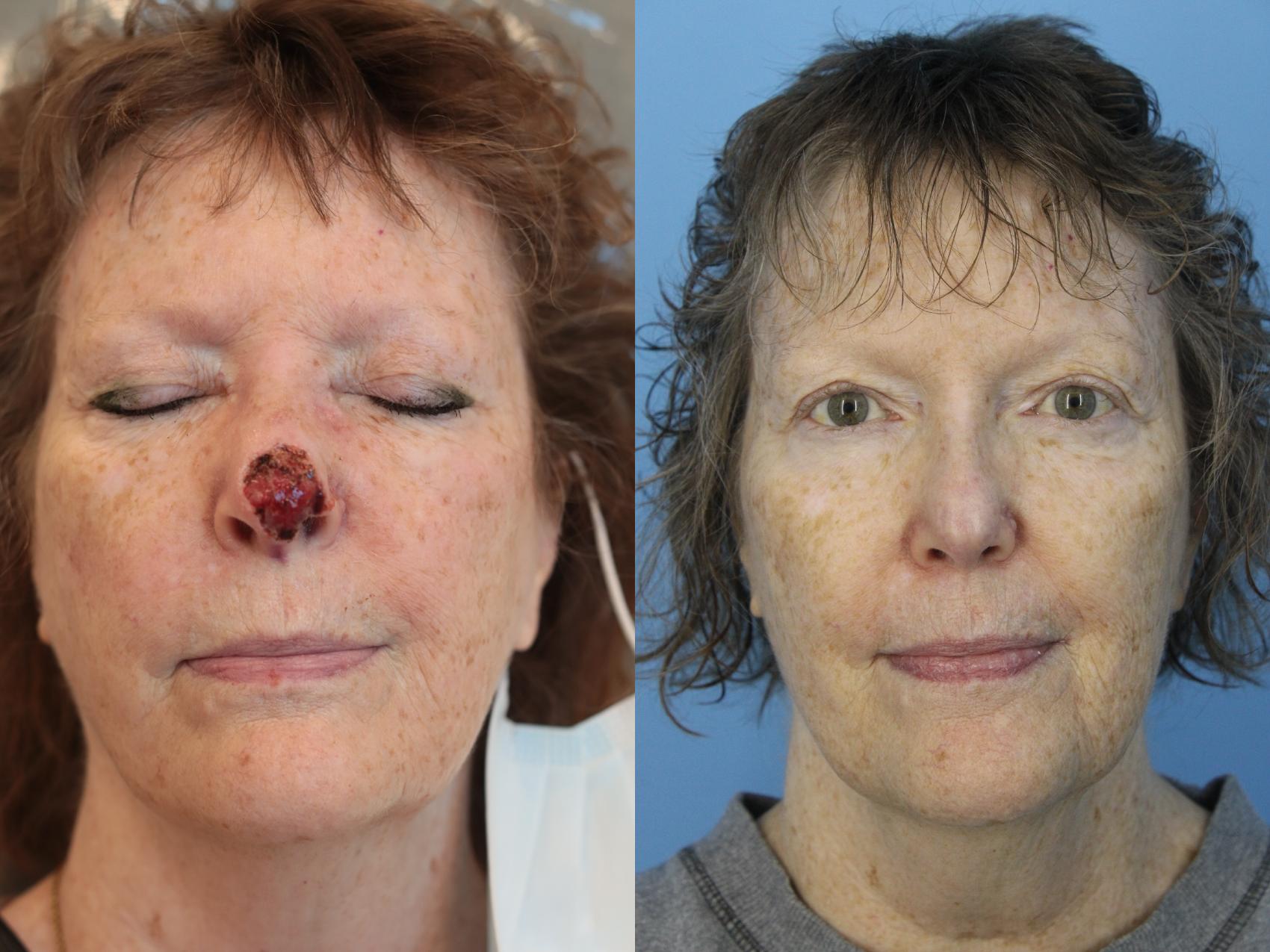 Before & After Skin Cancer Repair Case 469 Front View in West Des Moines & Ames, IA