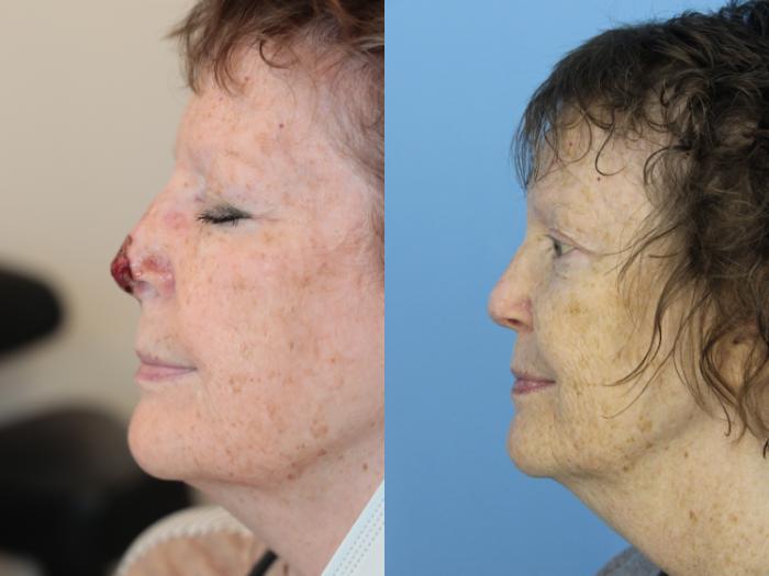 Before & After Skin Cancer Repair Case 469 Left Side View in West Des Moines & Ames, IA