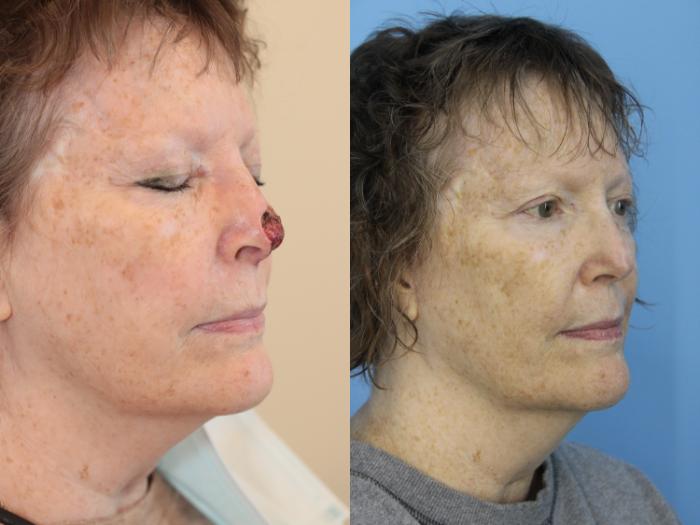 Before & After Skin Cancer Repair Case 469 Right Oblique View in West Des Moines & Ames, IA