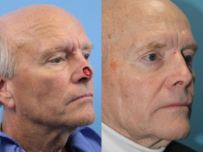 Before & After Skin Cancer Repair Case 479 Right Oblique View in West Des Moines & Ames, IA