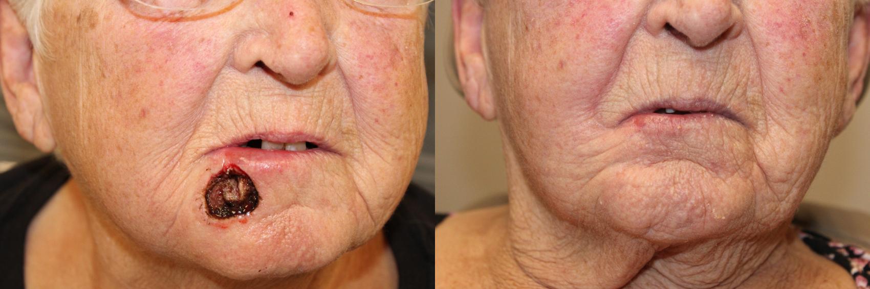 Before & After Skin Cancer Repair Case 492 Front View in West Des Moines & Ames, IA