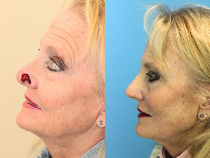 Before & After Skin Cancer Repair Case 495 Left Side View in West Des Moines & Ames, IA