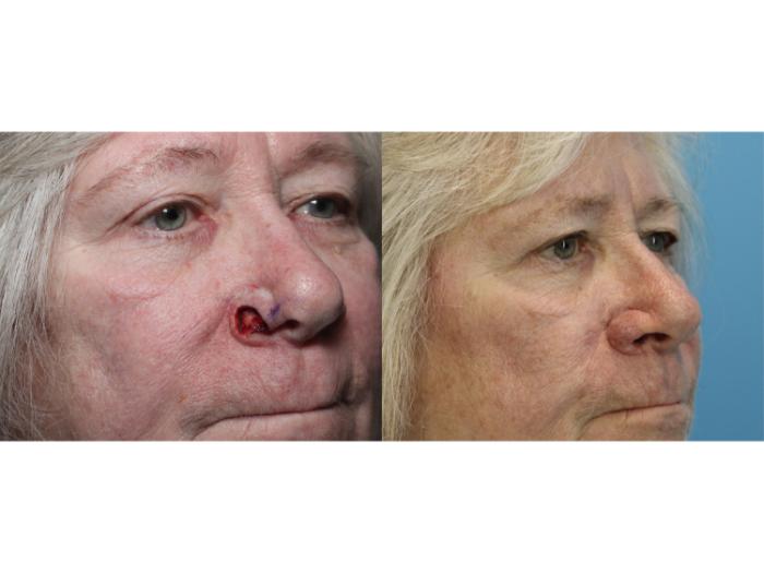 Before & After Skin Cancer Repair Case 565 Close Up View in West Des Moines & Ames, IA