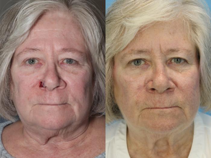 Before & After Skin Cancer Repair Case 565 Front View in West Des Moines & Ames, IA