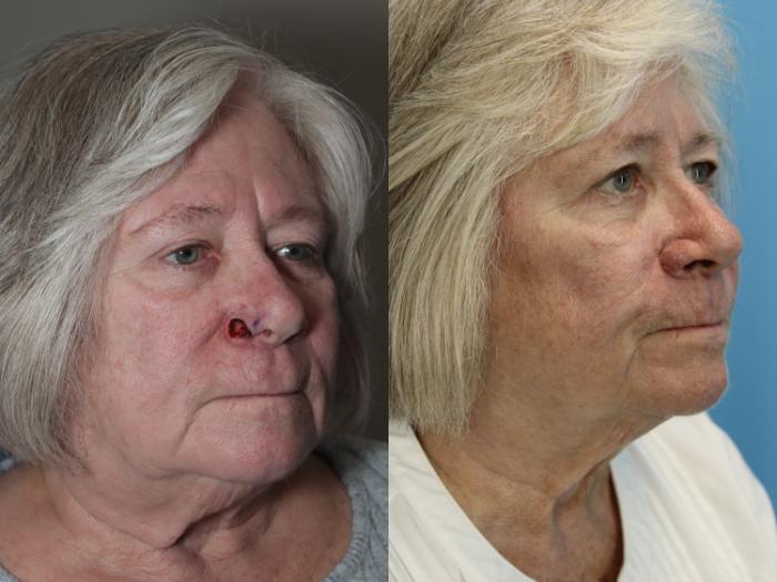 Before & After Skin Cancer Repair Case 565 Right Oblique View in West Des Moines & Ames, IA