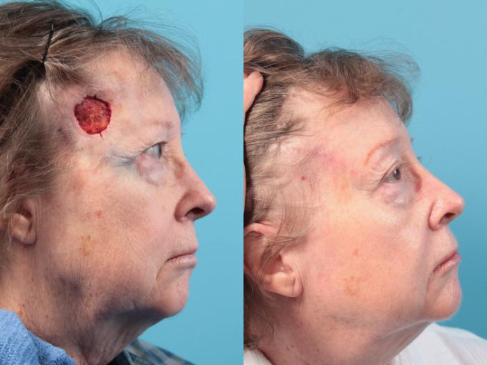 Before & After Skin Cancer Repair Case 59 View #1 View in West Des Moines & Ames, IA