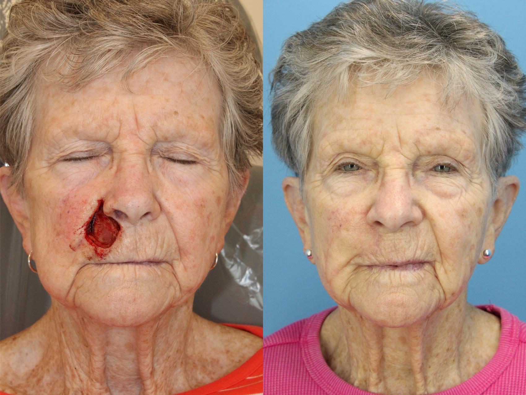 Before & After Skin Cancer Repair Case 604 Front View in West Des Moines & Ames, IA