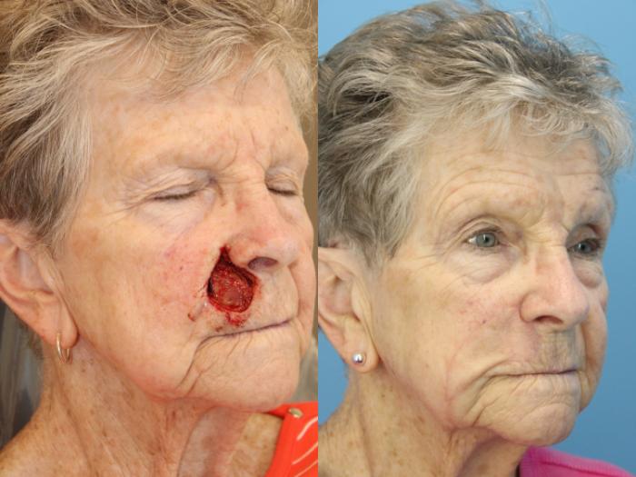 Before & After Skin Cancer Repair Case 604 Left Oblique View in West Des Moines & Ames, IA