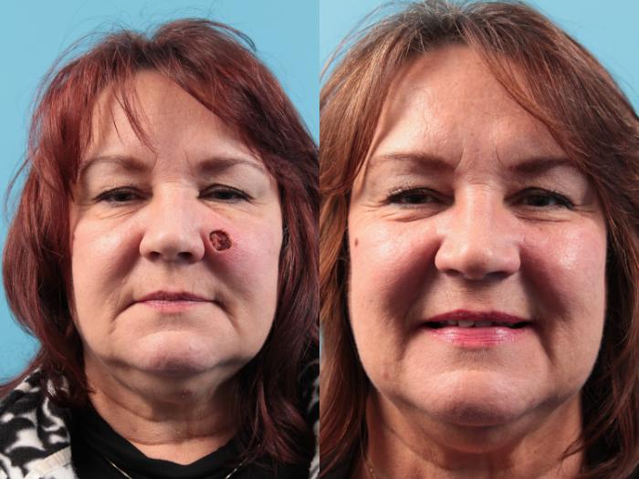 Before & After Skin Cancer Repair Case 69 View #1 View in West Des Moines & Ames, IA