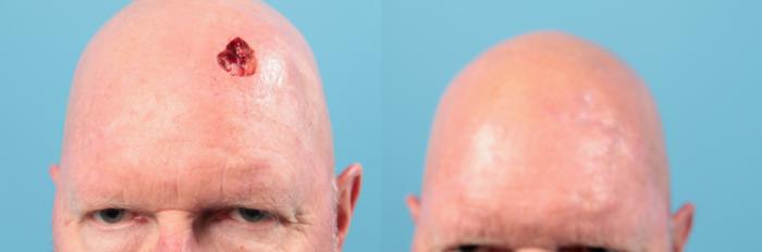 Before & After Skin Cancer Repair Case 82 View #1 View in West Des Moines & Ames, IA