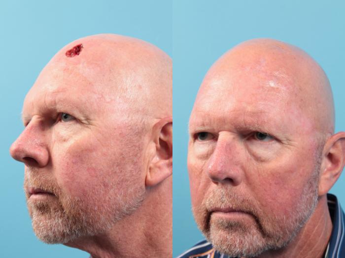 Before & After Skin Cancer Repair Case 82 View #2 View in West Des Moines & Ames, IA
