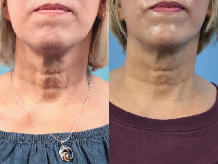 Before & After SkinTyte® Case 118 Front View in West Des Moines & Ames, IA