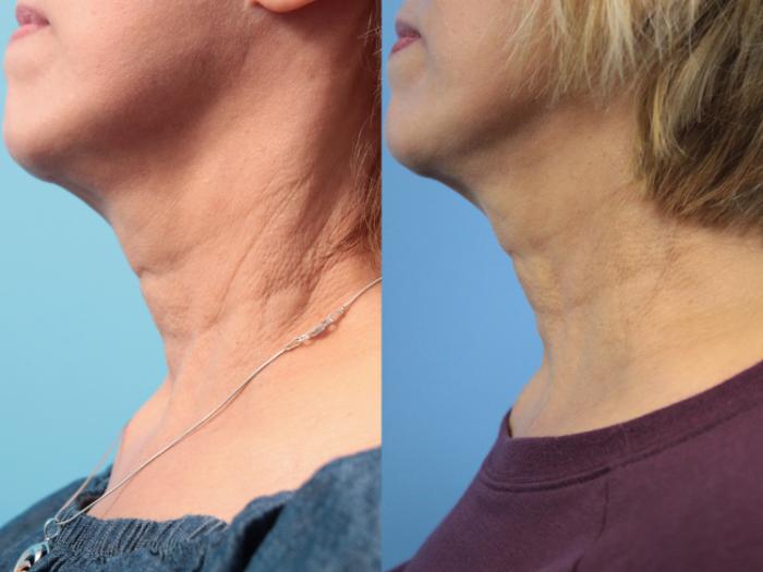 Before & After SkinTyte® Case 118 Left Side View in West Des Moines & Ames, IA