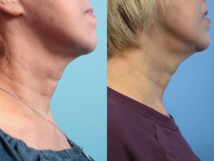 Before & After SkinTyte® Case 118 Right Side View in West Des Moines & Ames, IA