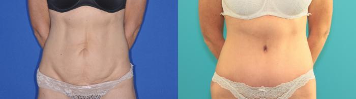 Before & After Tummy Tuck Case 199 Front View in West Des Moines & Ames, IA