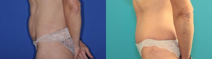 Before & After Tummy Tuck Case 199 Left Side View in West Des Moines & Ames, IA
