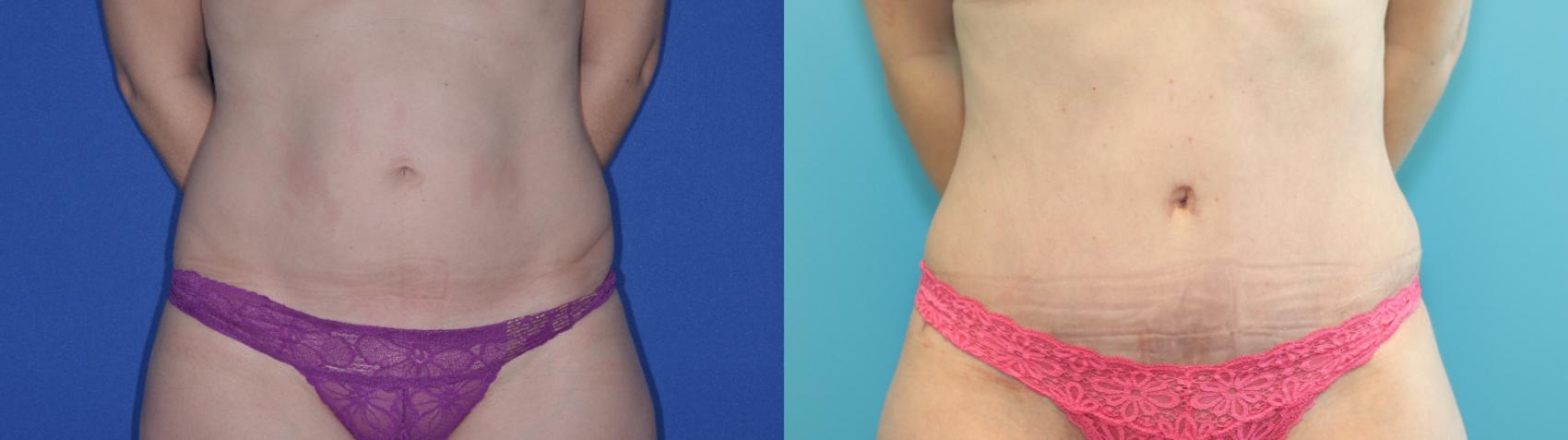 Before & After Tummy Tuck Case 201 Front View in West Des Moines, IA