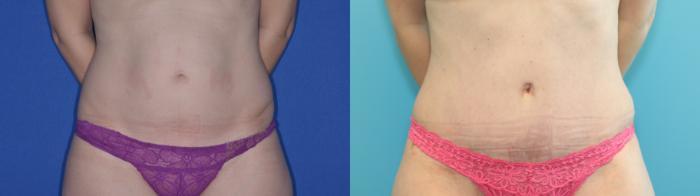 Before & After Tummy Tuck Case 201 Front View in West Des Moines & Ames, IA