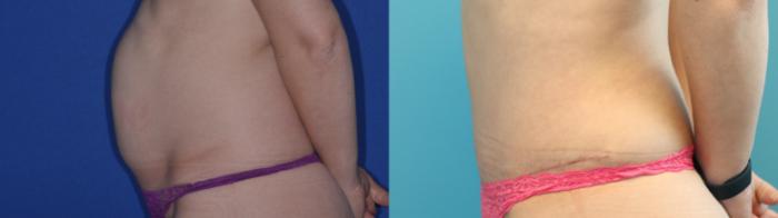 Before & After Tummy Tuck Case 201 Left Side View in West Des Moines & Ames, IA