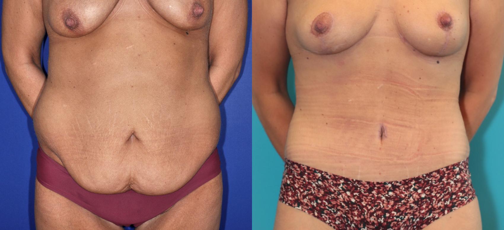 Before & After Tummy Tuck Case 204 Front View in West Des Moines, IA