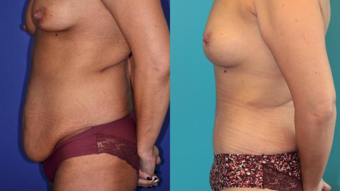 Before & After Tummy Tuck Case 204 Left Side View in West Des Moines & Ames, IA