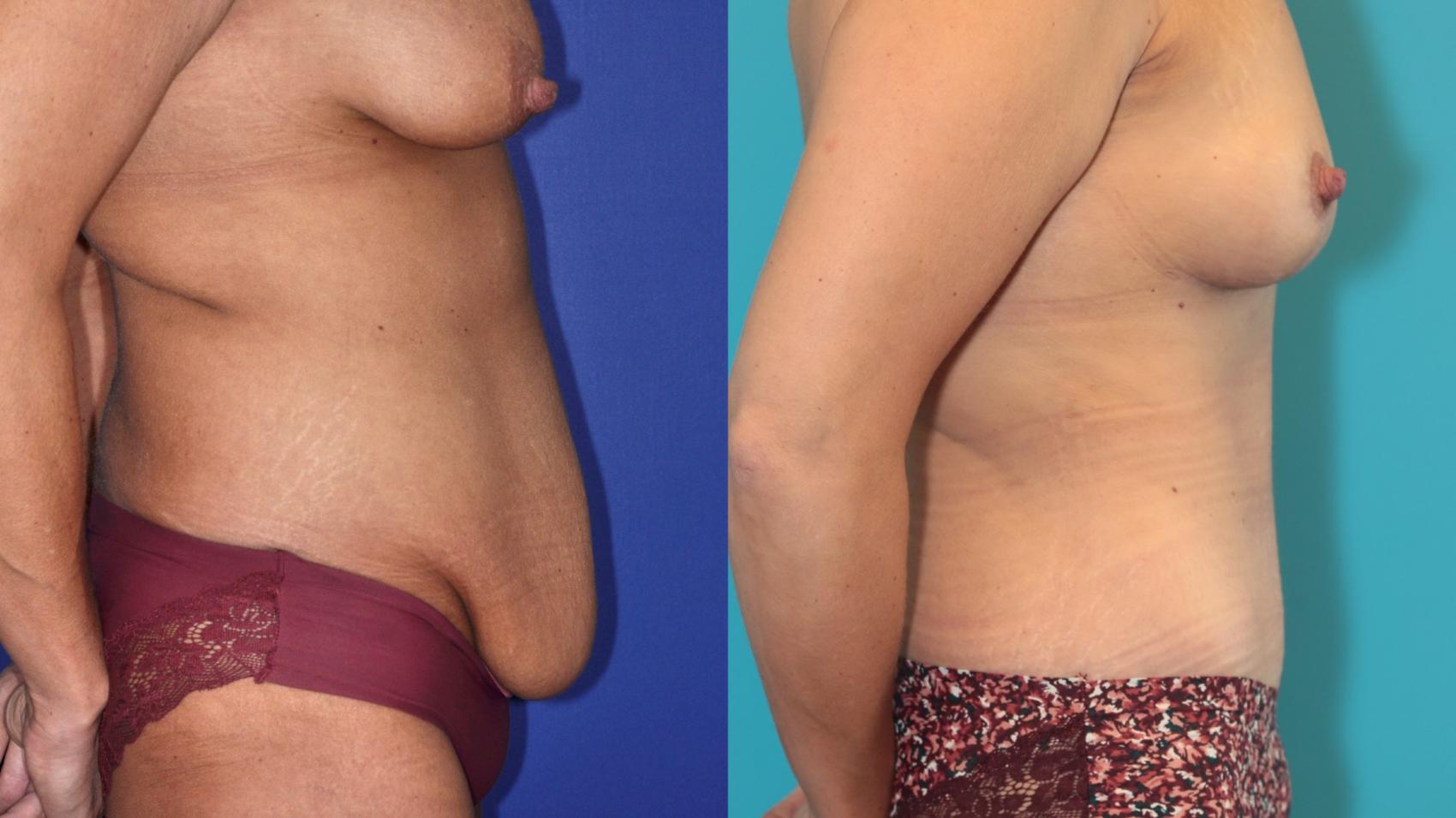 Before & After Tummy Tuck Case 204 Right Side View in West Des Moines, IA
