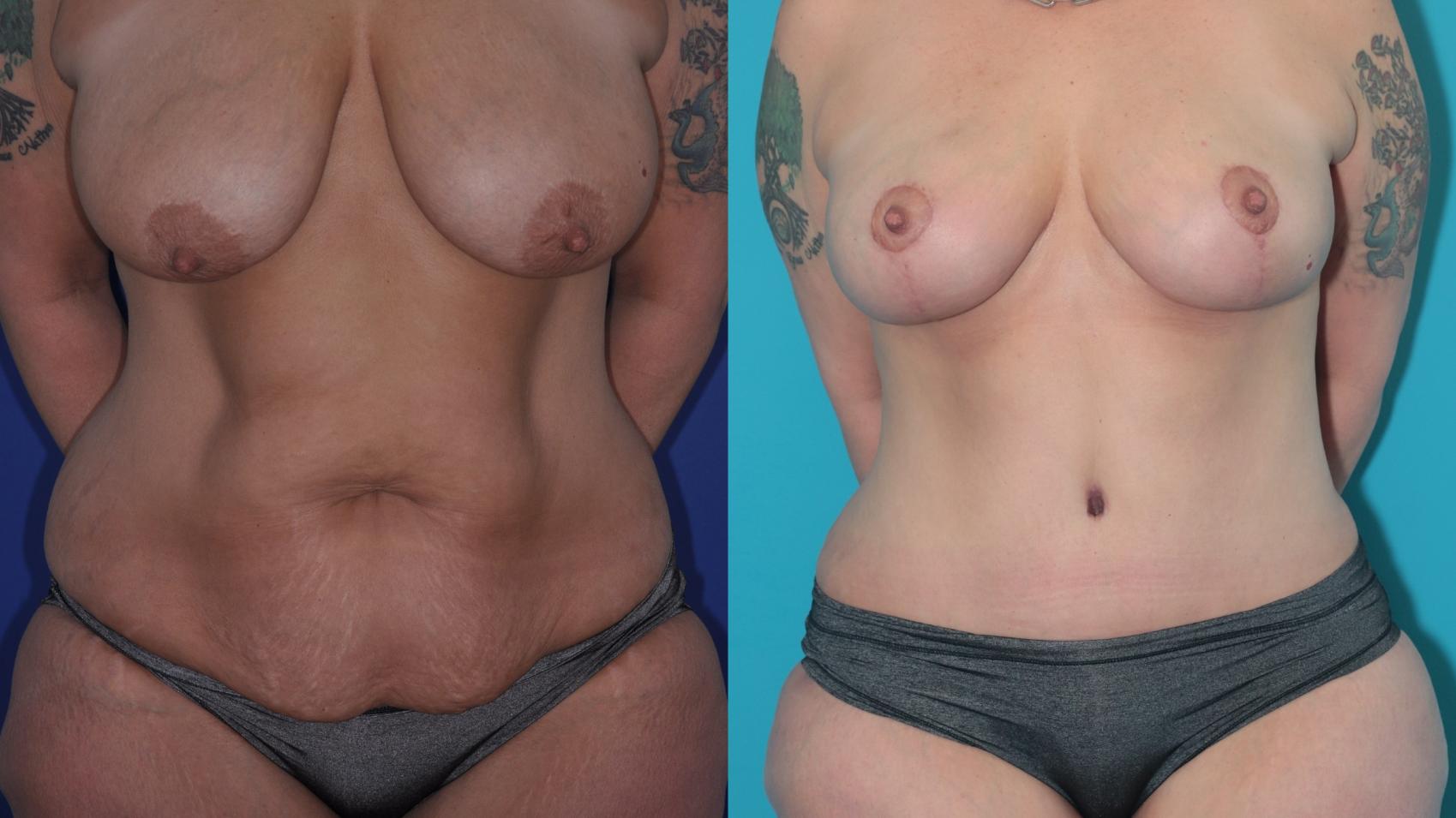 Before & After Tummy Tuck Case 209 Front View in West Des Moines, IA