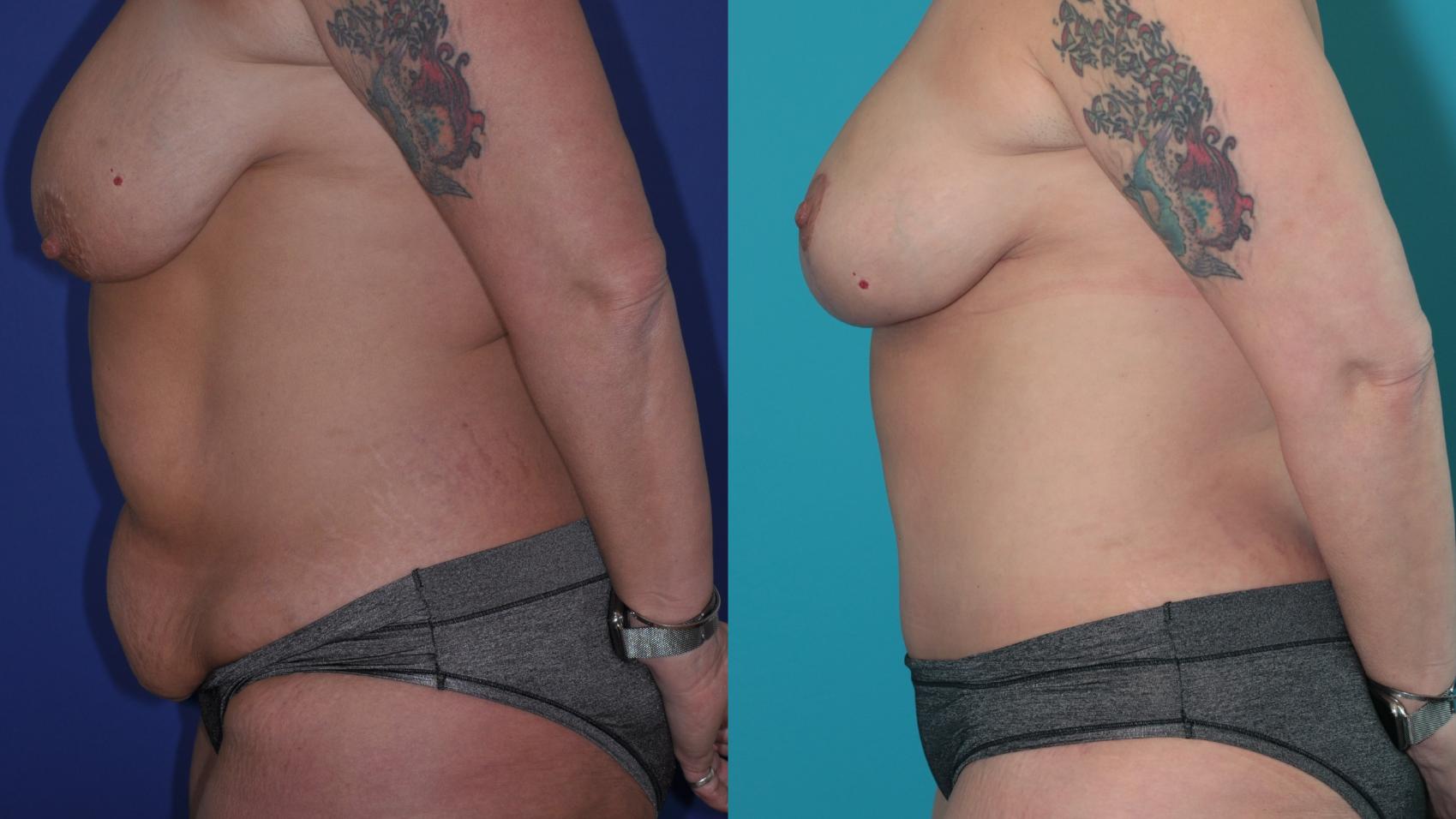 Before & After Tummy Tuck Case 209 Left Side View in West Des Moines & Ames, IA