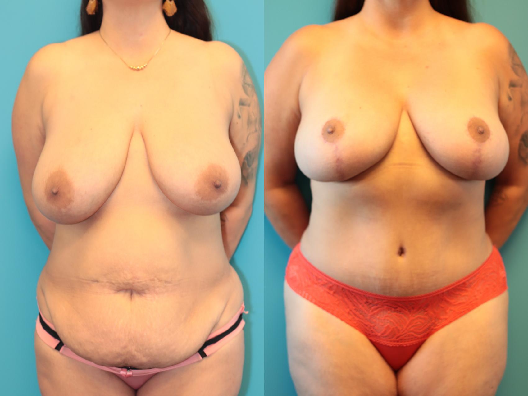 Before & After Tummy Tuck Case 275 Front View in West Des Moines, IA