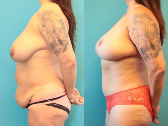 Before & After Breast Lift Case 275 Left Side View in West Des Moines & Ames, IA
